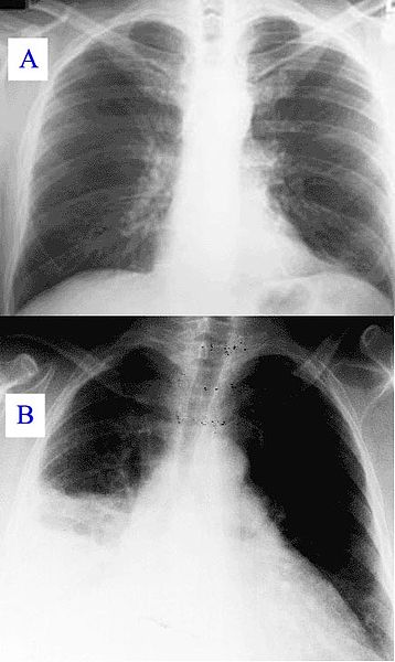 <p>Healthy Lung and Q Fever Pneumatic Lung, Chest X-ray