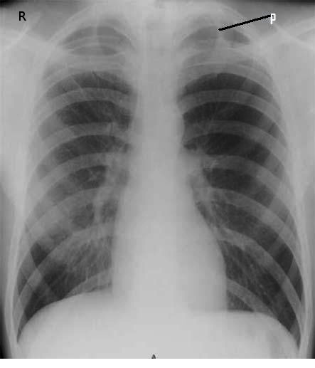 <p>Primary Spontaneous Pneumothorax. Radiographic image revealing a left apical pneumothorax.</p>