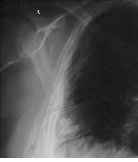 <p>Chest Tube on Plain Radiograph
