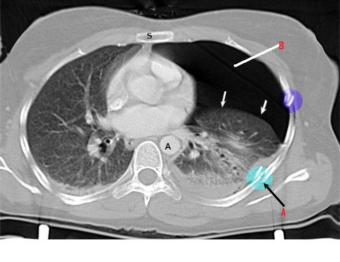 <p>Rib Fracture
