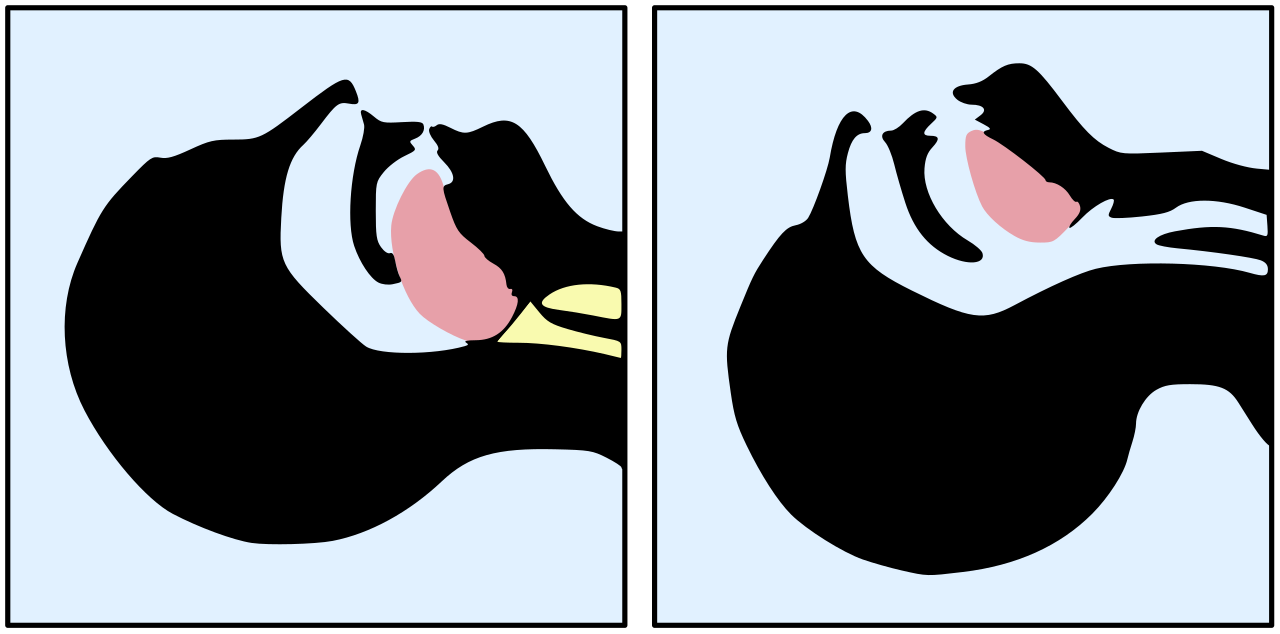 <p>Head Tilt-Chin Lift Maneuver