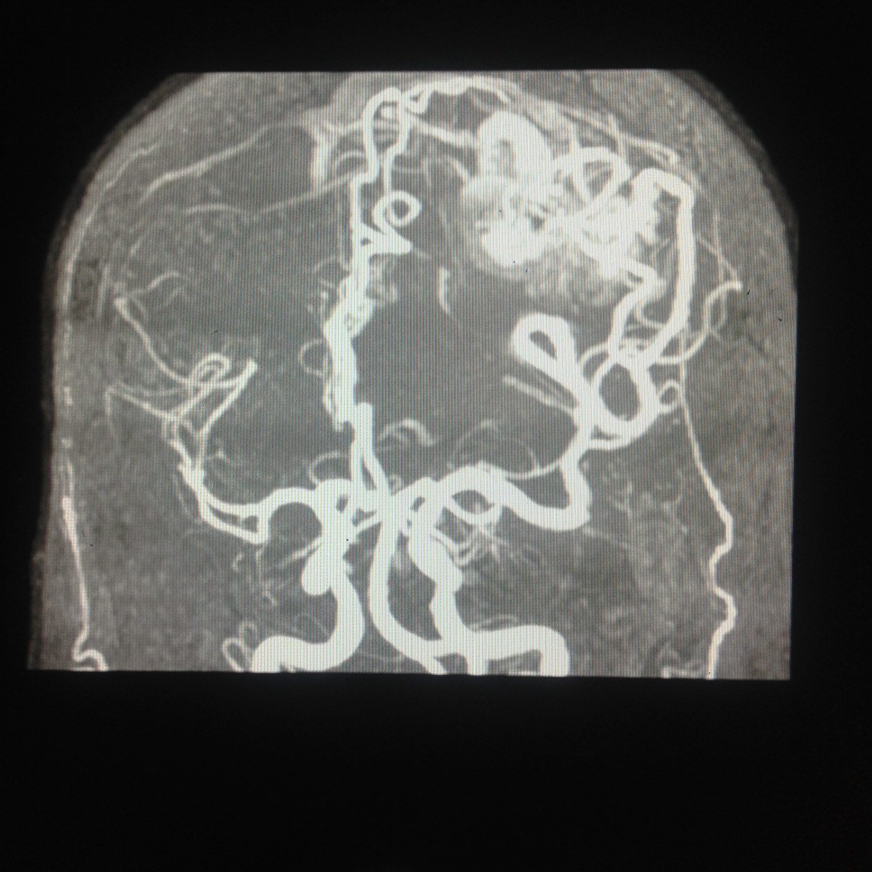 <p>Middle Cerebral Artery on Magnetic Resonance Angiography