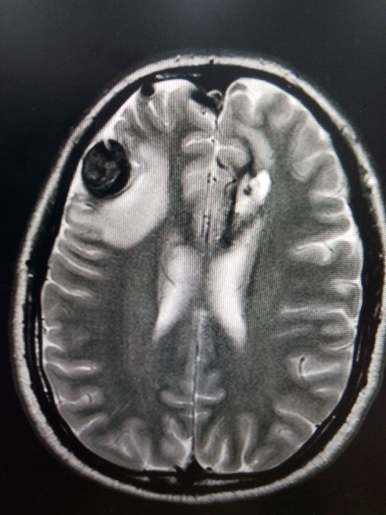 <p>AVM&nbsp;With Aneurysm and Intraparenchymal Bleeding on MRI