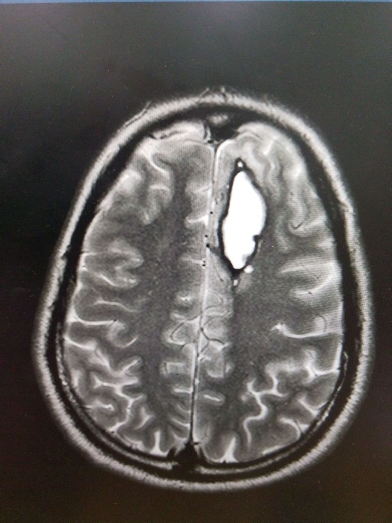 <p>Aneurysm Formation and Intraparenchymal Bleed on MRI