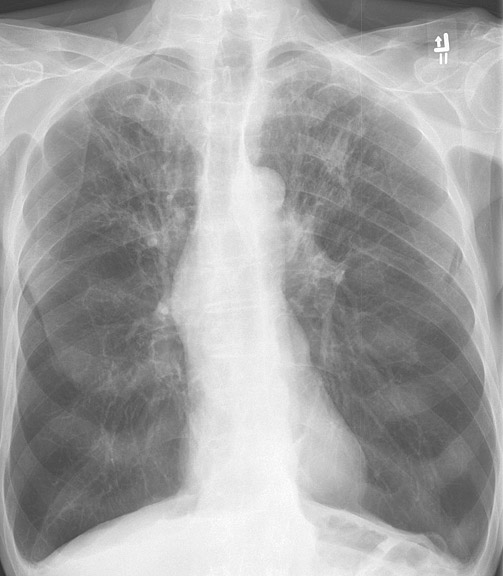 <p>X-Ray, Chest, Chronic Obstructive Pulmonary Disease, Anterior</p>
