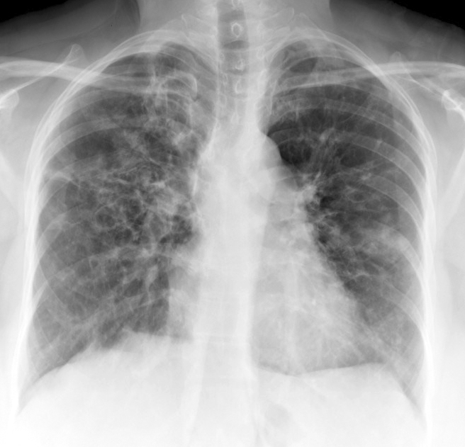<p>Chronic Obstructive Pulmonary Disease, Allergic Bronchopulmonary Aspergillosis