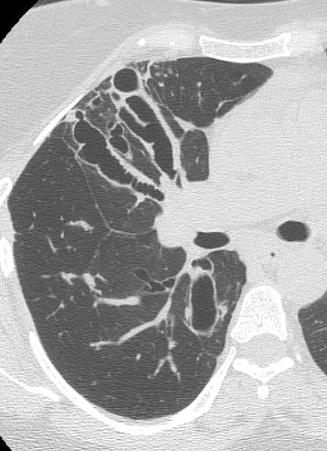 <p>Chronic Obstructive Pulmonary Disease, Allergic Bronchopulmonary Aspergillosis, CT Scan</p>