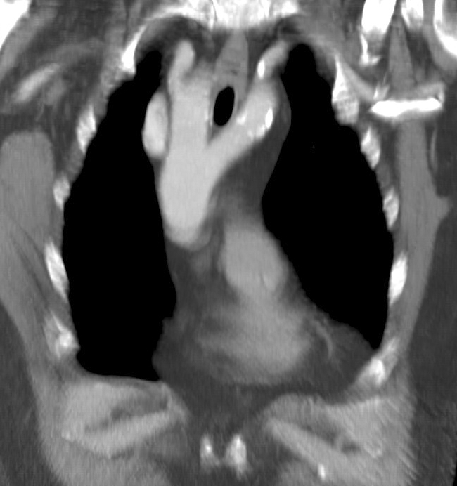 <p>Cardiac Computed Tomography, Double Aortic Arch</p>
