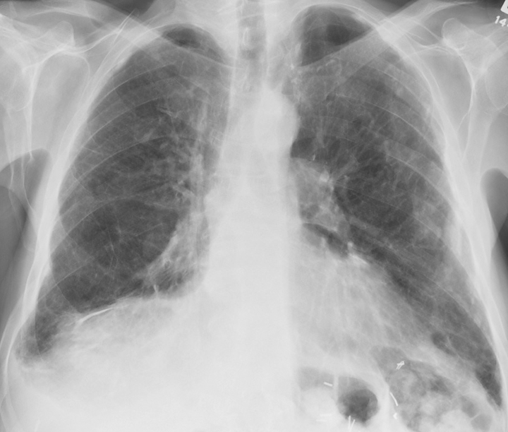 <p>Lung Asbestosis, Radiograph. This image shows an anterior view of the lungs with asbestosis on radiograph.</p>