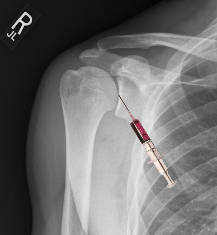 <p>Anterior Approach for Shoulder Arthrocentesis