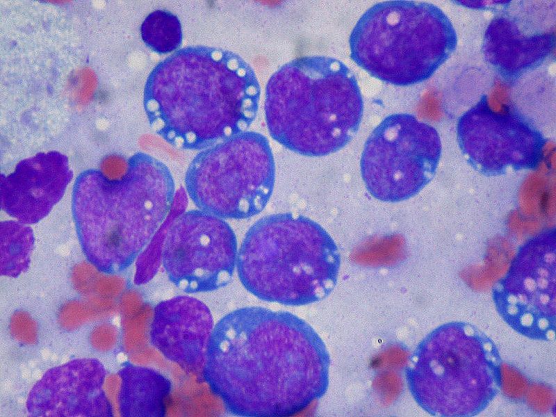 <p>Burkitt Lymphoma, Lymphoblasts