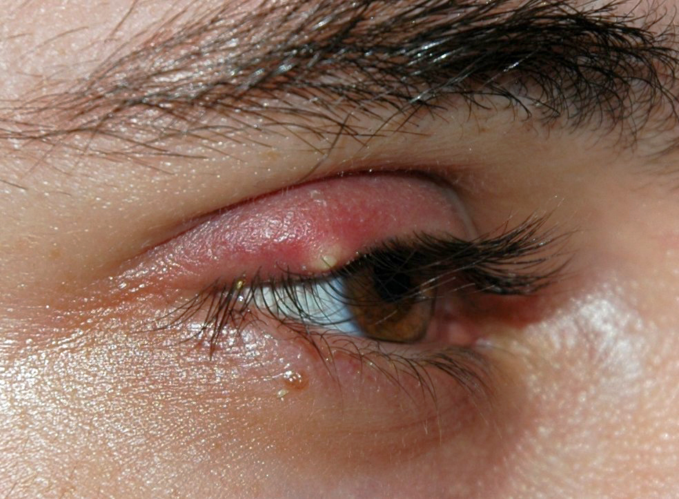 <p>External Hordeolum of the Upper Eyelid. Note the pustule and surrounding erythema at the eyelash bases.</p>