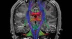 <p>Coronal Tractography, Corpus Callosum