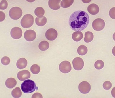 <p>Macrocytic Anemia