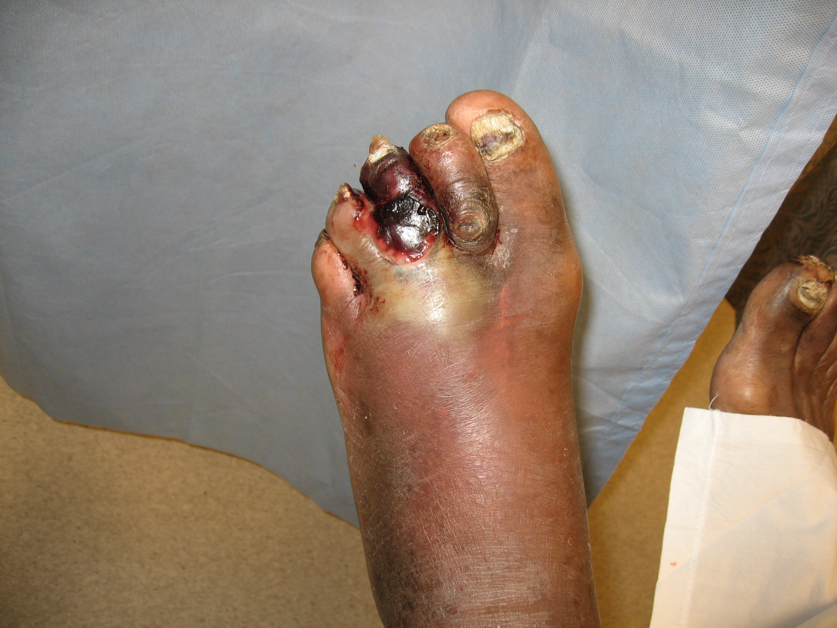 <p>Gas Gangrene of a Diabetic Foot. Gas-producing gram-negative organisms are also common in diabetic foot infections.</p>