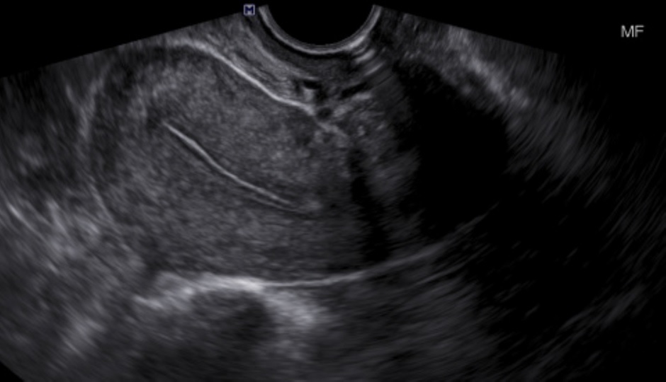 <p>Transvaginal Long Image of a Normal Uterus. Note the bladder is not fluid-filled nor readily visible.</p>