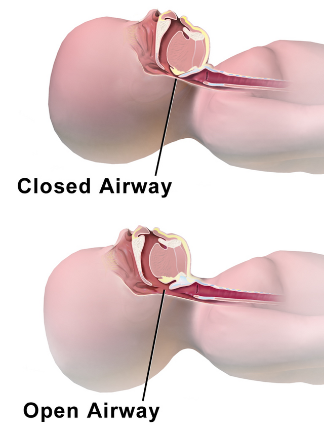 <p>Infant Airway