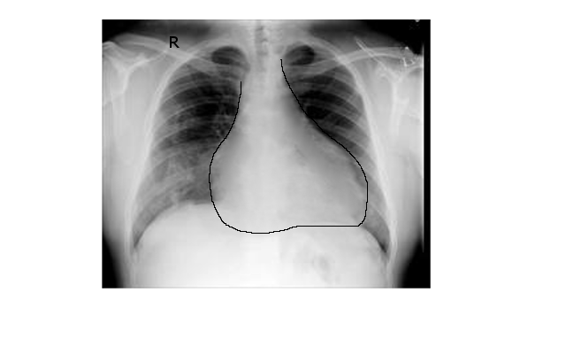 pericardial effusion