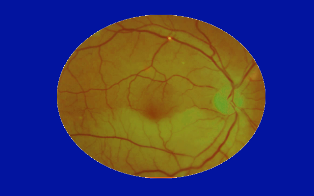 <p>Amaurosis Fugax. This funduscopic image shows retinal hemorrhage and dilated retinal vessels.</p>
