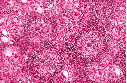 <p>Hashimoto Thyroiditis