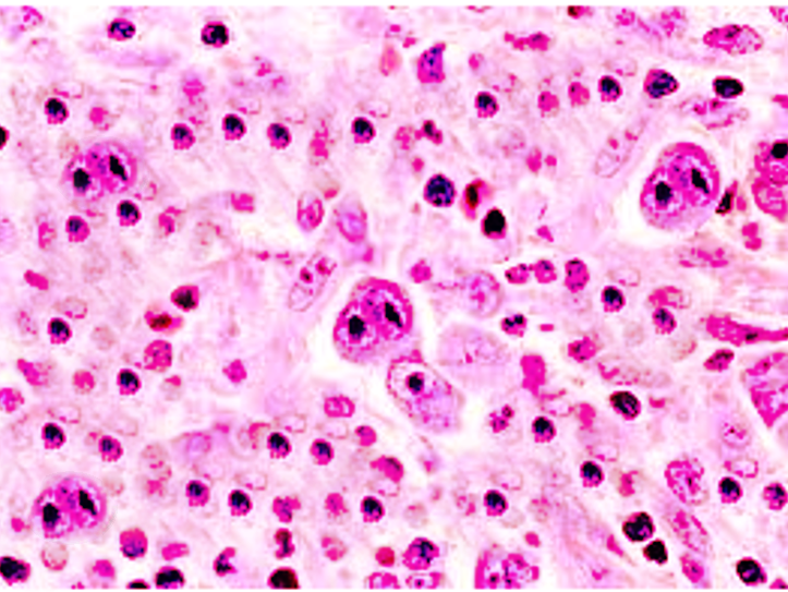 <p>Reed Sternberg Cells