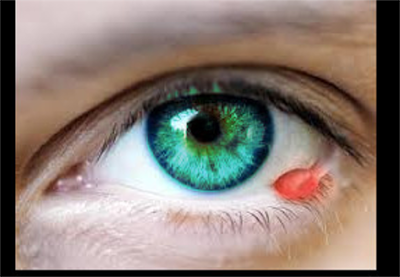 <p>Lower Eyelid Hordeolum. Note the erythematous appearance at the lower lid margin.</p>