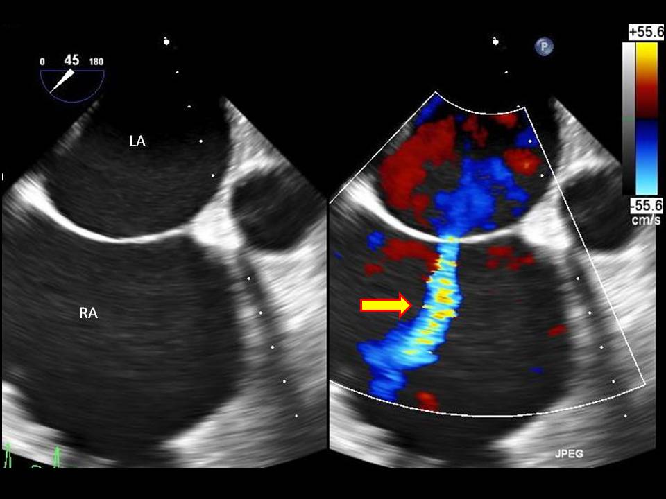 <p>Atrial Septal Defect on Ultrasound with Doppler Study