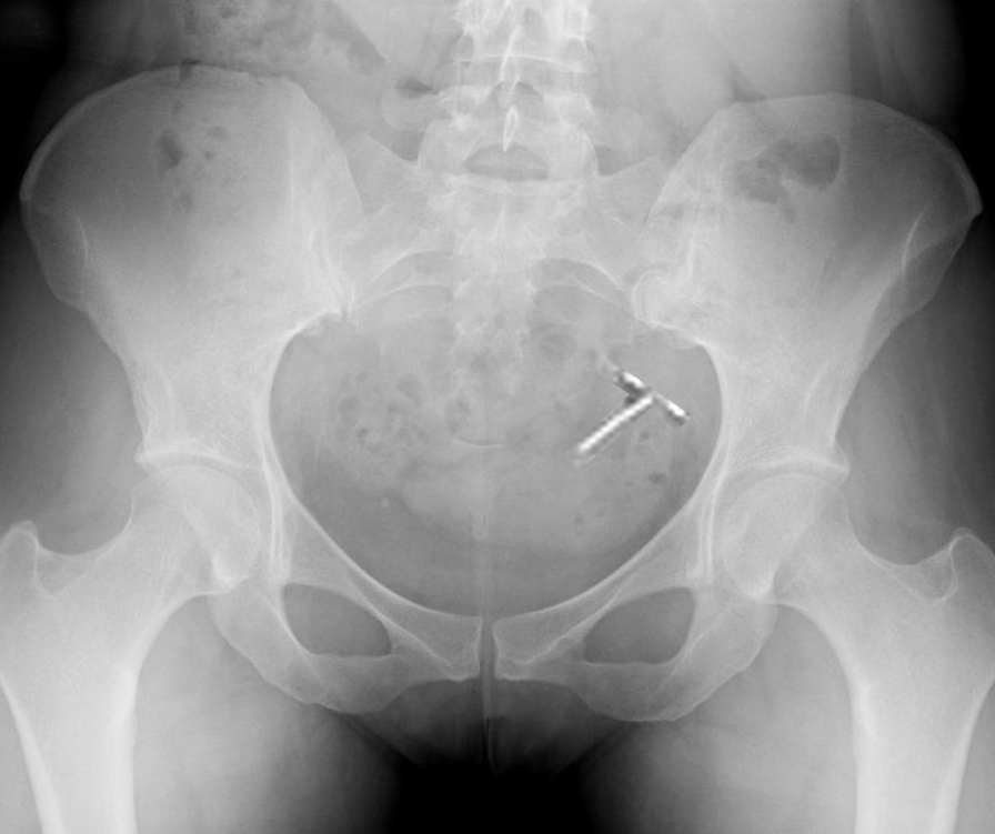 <p>Plain Radiograph Showing Intrauterine Device Malposition