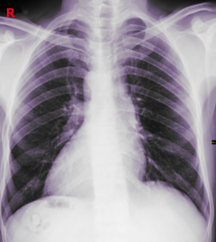 <p>Dextrocardia, Chest Radiograph