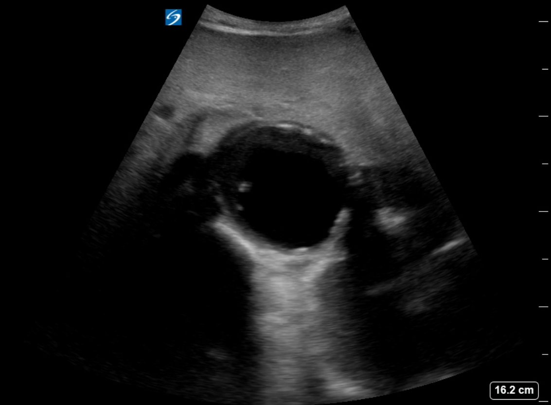 <p>Abdominal Aortic Aneurysm, Ultrasound. The diagnosis of an abdominal aortic aneurysm is usually made using ultrasound.</p>