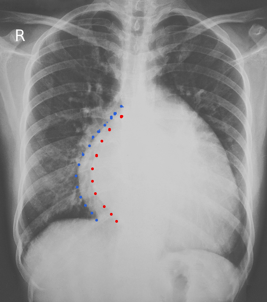 <p><strong>Left Atrial Enlargement.</strong> Chest radiograph outlining an enlarged cardiac silhouette.&nbsp;</p>