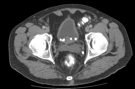 <p>Computed Tomography Scan of the Pelvis