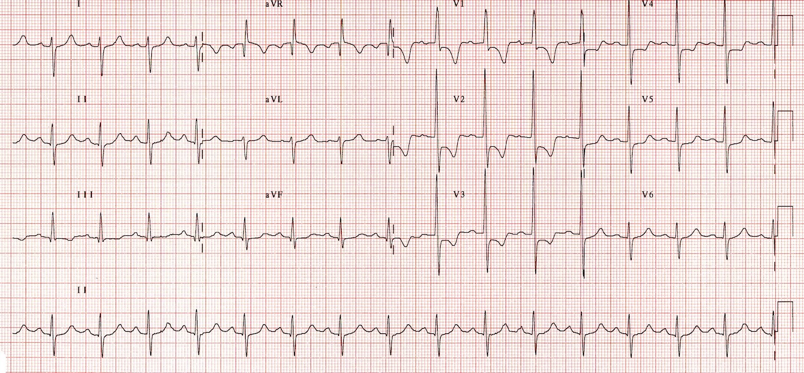 <p>Right Ventricular Hypertrophy Electrocardiography