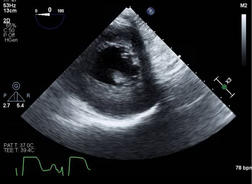 <p>Papillary Muscle Rupture on Transesophageal Echocardiography
