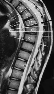 <p>Hyperkyphosis