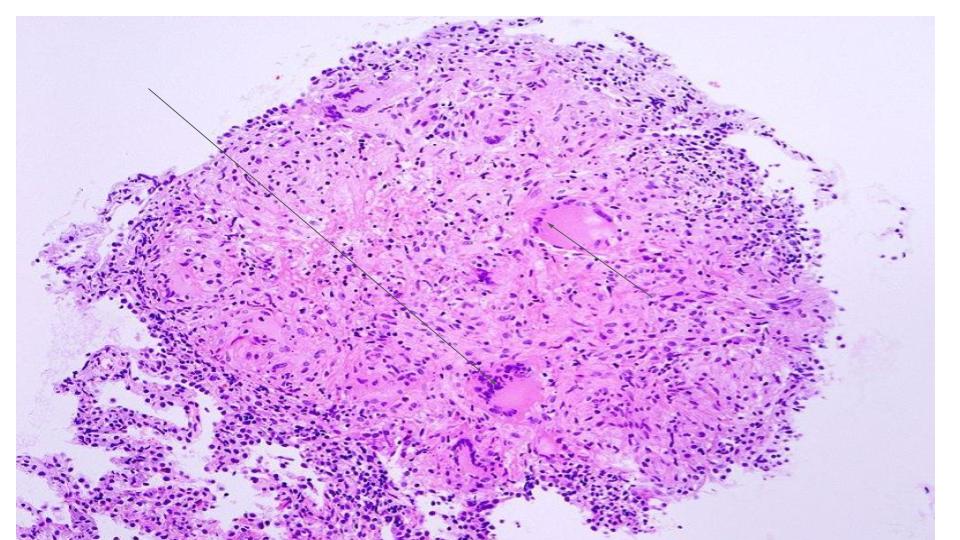 <p>Granuloma of Tuberculosis. Arrows pointed at multinucleated giant cells.</p>