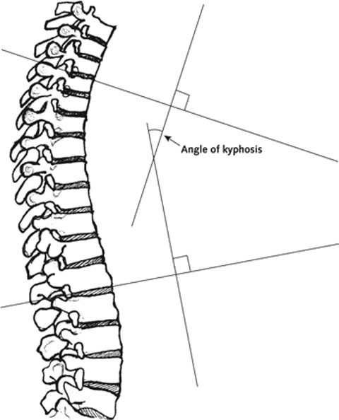 <p>Kyphosis Imaging Techniques