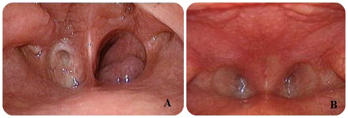 <p>Choanal Atresia on Nasal Endoscopy