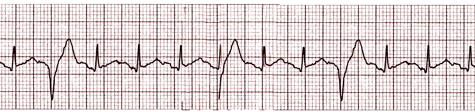 <p>Premature Ventricular Complex on Electrocardiogram