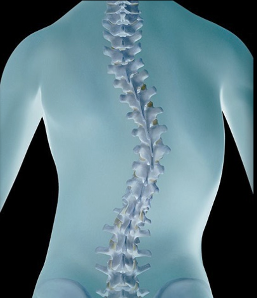 <p>Scoliosis of the Spine.</p>