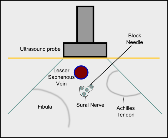 <p>Sural Nerve Block In-Plane Technique.</p>