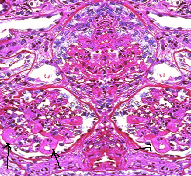<p>Lupus Nephritis With Wire Loop Lesions.</p>