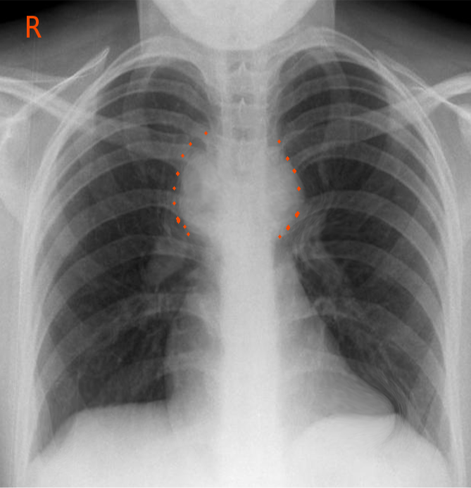 <p>Mediastinal Adenopathy</p>
