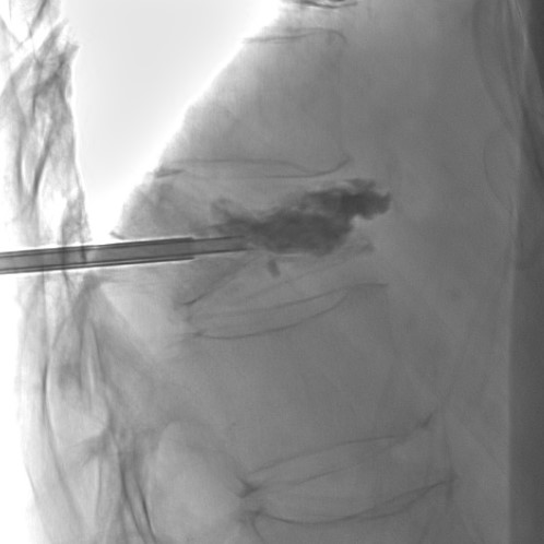 <p>Fluoroscopic Image of Cement Injection During Percutaneous Kyphoplasty