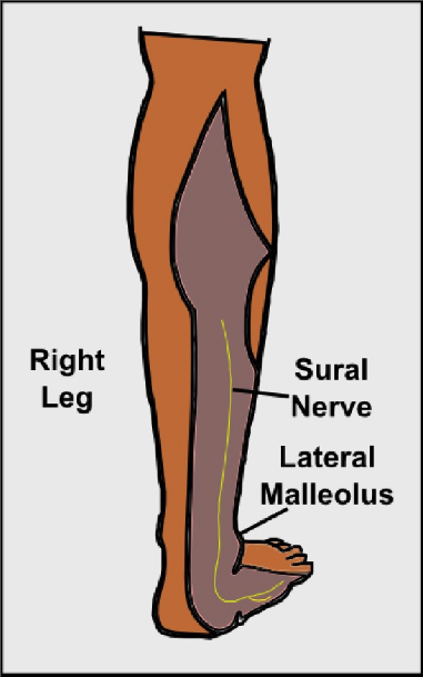 <p>Sural Nerve in Right Leg.</p>