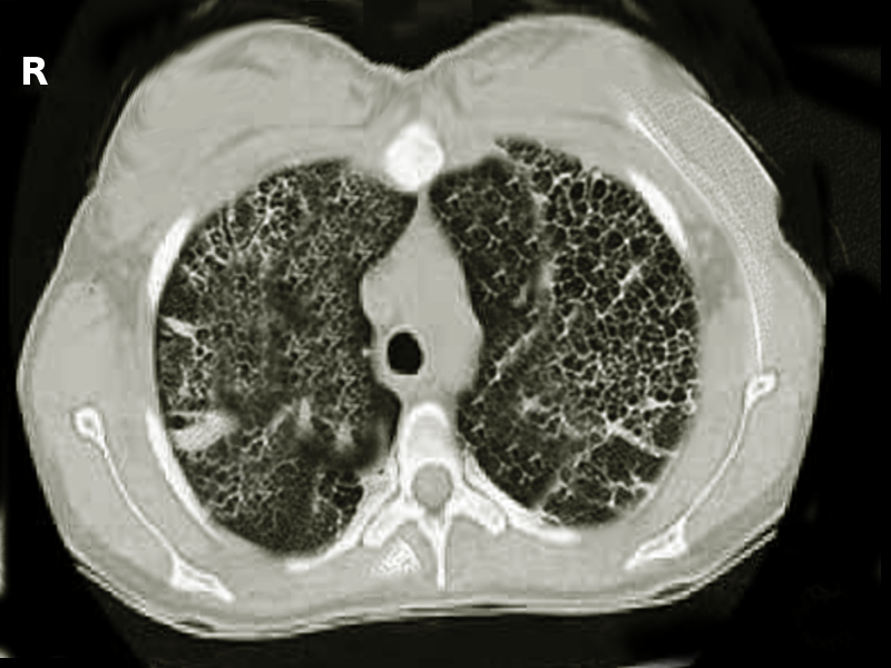 <p>Lung Fibrosis</p>