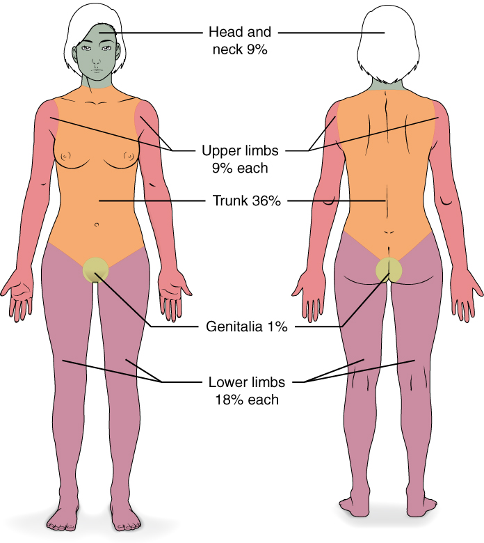 Wallace Rule of Nines for determining percent of burned body surface area.