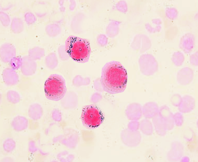 <p>Ringed Sideroblasts. This image shows ringed sideroblasts in dark pink.</p>