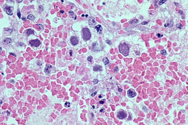 <p>Adenovirus, Smudge Cells</p>