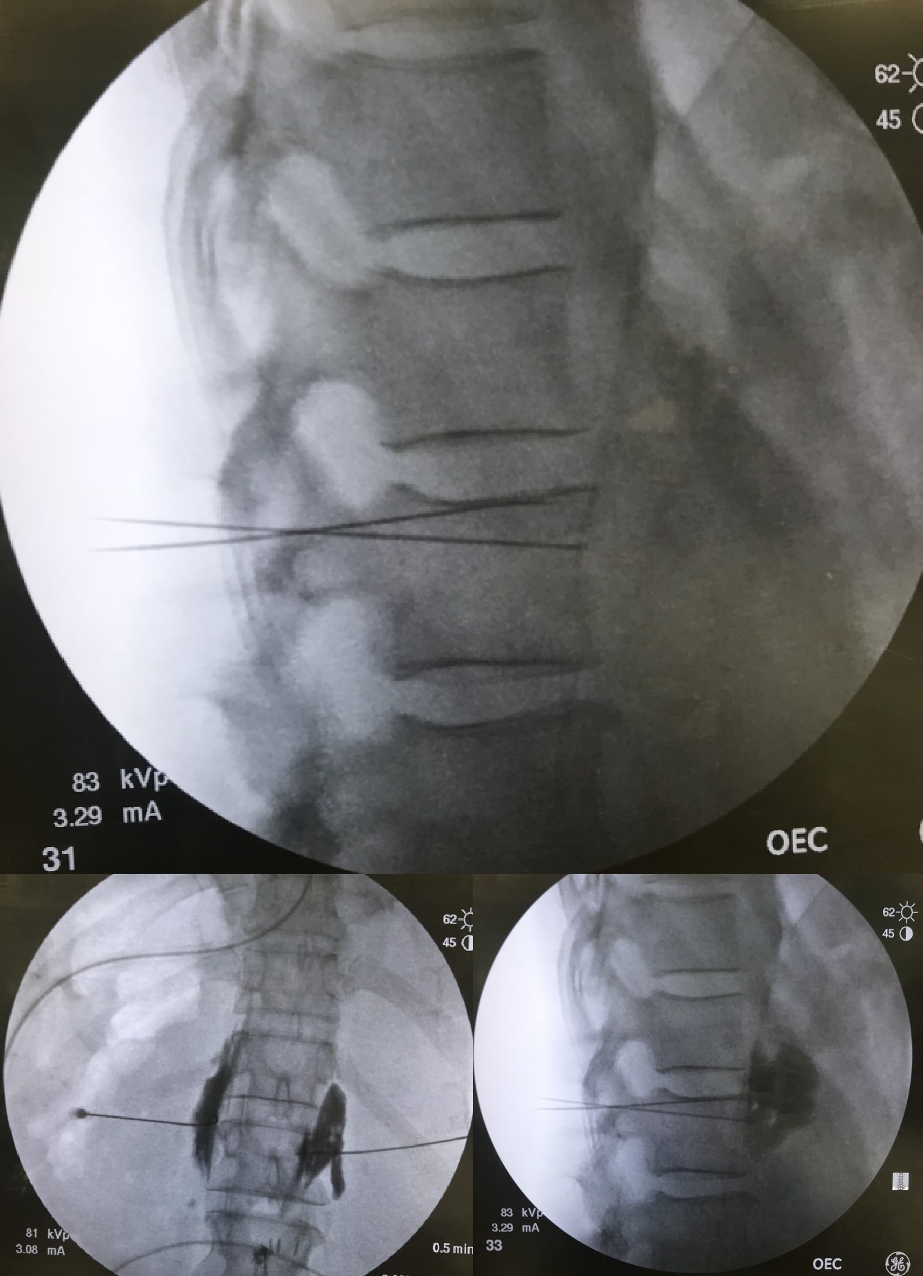 <p>Neurolytic Celiac Plexus Block, Radiograph